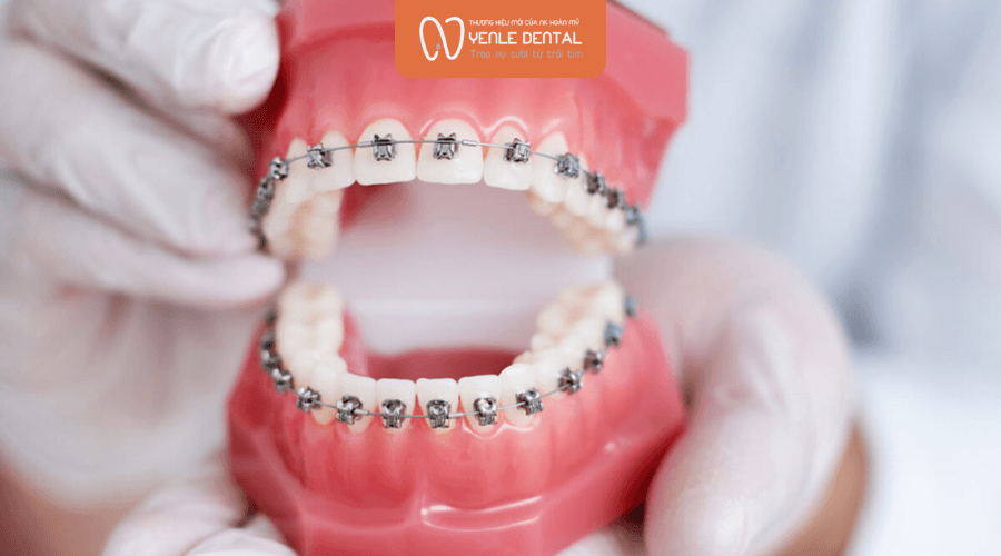 Niềng răng mắc cài kim loại lưu ý gì